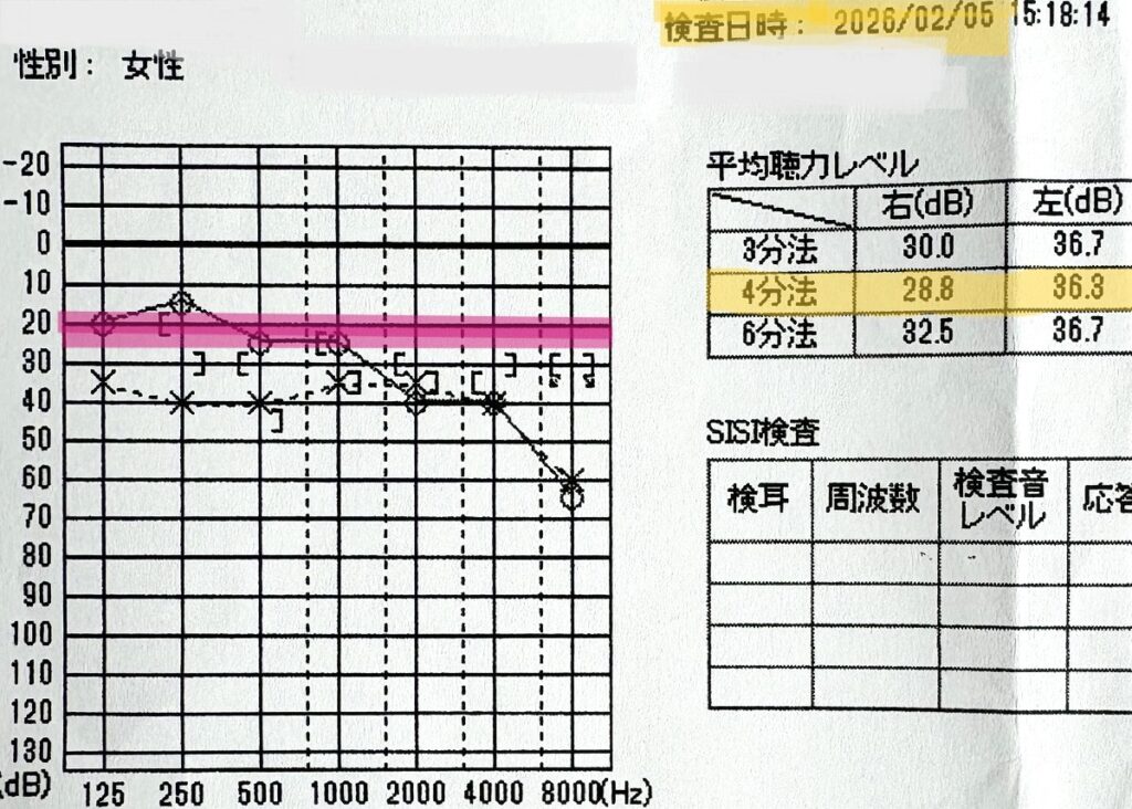 メニエール病の経過観察として記録された2026年2月5日の聴力検査