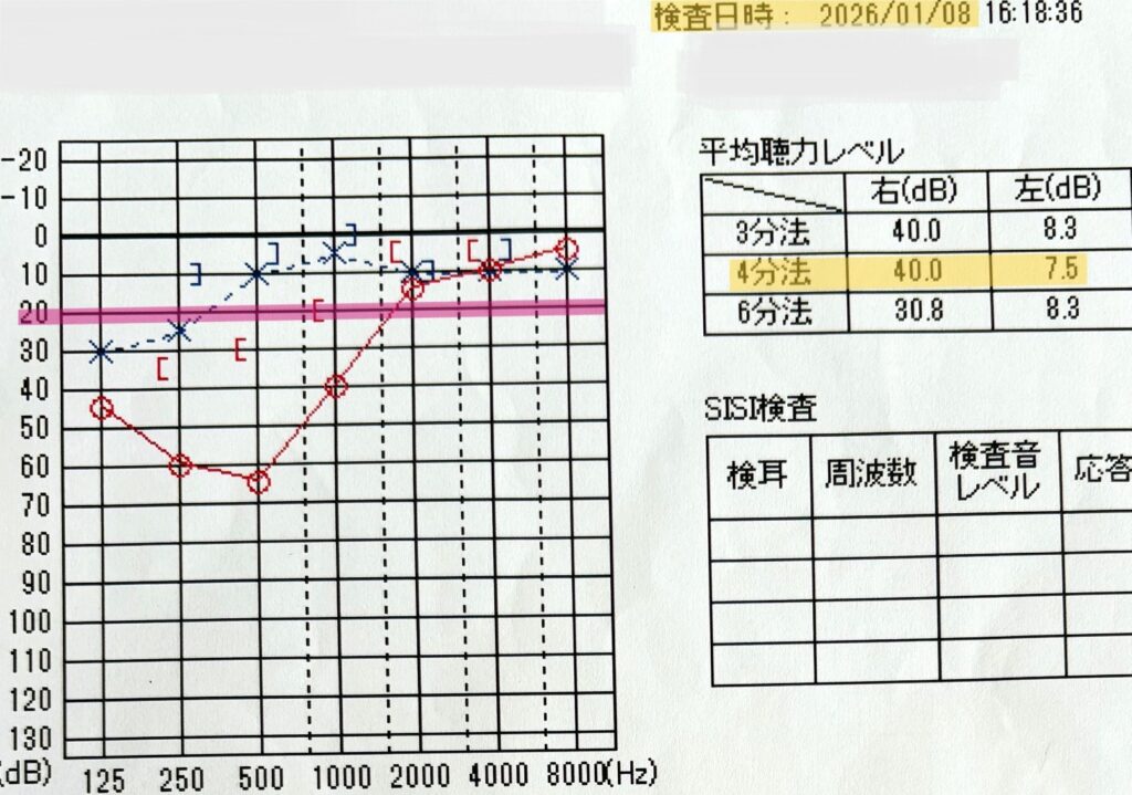中等度低音障害型感音難発症の経過観察として記録された2026年1月8日の聴力検査