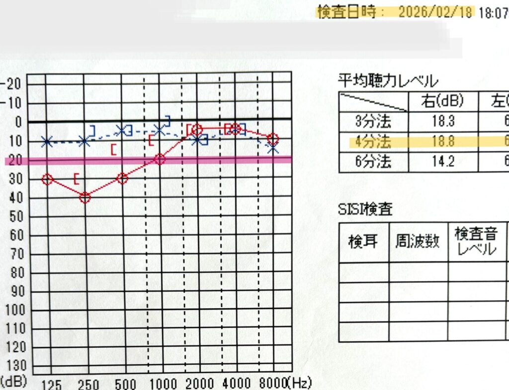 中等度低音障害型感音難発症の経過観察として記録された2026年2月18日の聴力検査