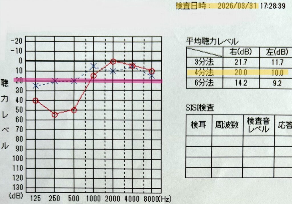 中等度低音障害型感音難発症の経過観察として記録された2026年3月31日の聴力検査