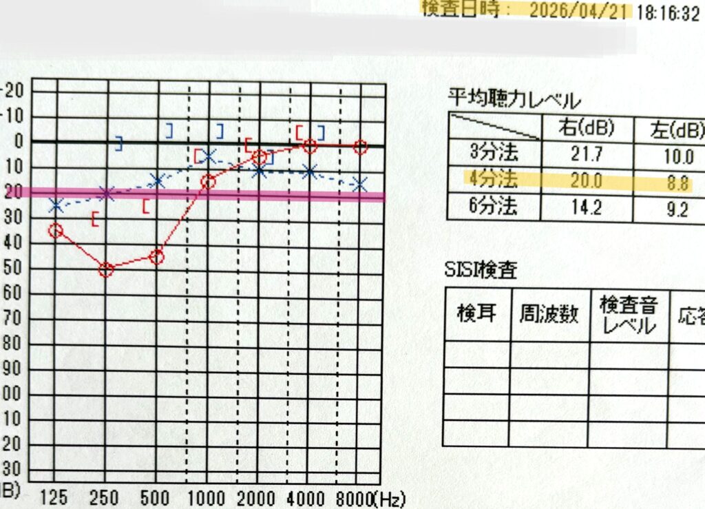 中等度低音障害型感音難発症の経過観察として記録された2026年4月21日の聴力検査